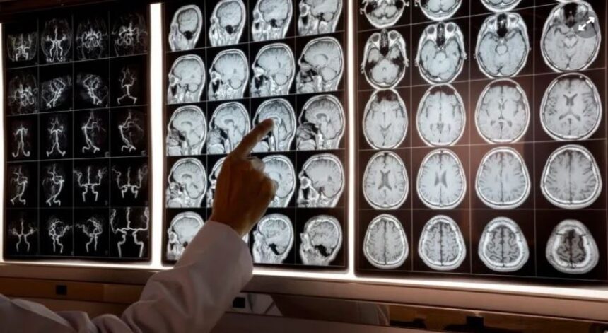 fdsdfsdf Día Mundial del Ataque Cerebral: todo lo que hay que saber