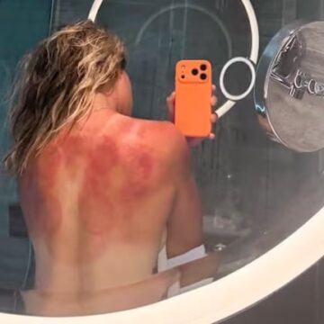 Tenista mexicana genera preocupación al mostrar quemaduras severas por altas temperaturas