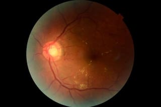 Innovadora IA del Conicet mejora los diagnósticos oftalmológicos de la diabetes